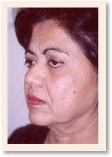 Before Photo of Brow Lift