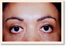 After Photo of Brow Lift