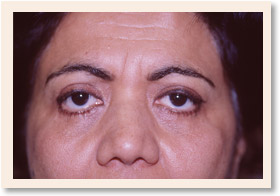 Before Photo of Brow Lift