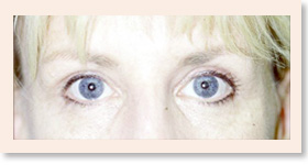 After Photo of Brow Lift