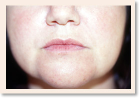 Photo of Pre Collagen Injection