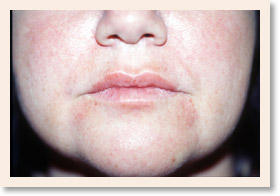 Photo of Post Collagen Injection