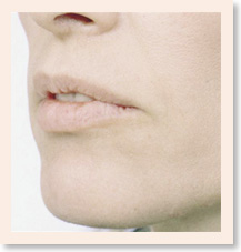 Photo - Before upper lip treatment