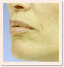 Photo - After insertion of soft tissue implants to upper lip.