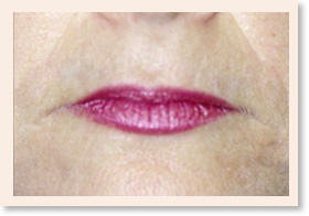 Photo - Before upper and lower lip treatment