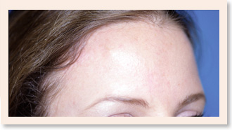 Photo of Facial Scar Revision - After
