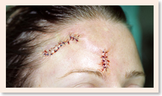 Photo of Facial Scar Revision - Before